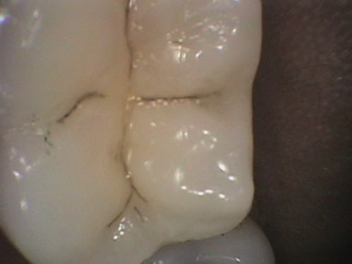 80% des caries se trouvent sur les dents qui ont des sillons.